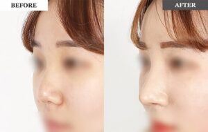 鼻整形症例1