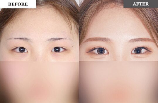 二重整形 症例1