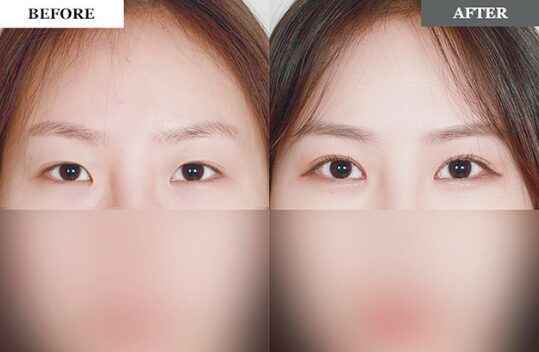 二重整形 症例2