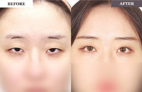 二重整形 症例3