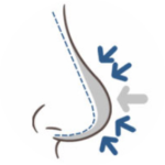 団子鼻 あぐら鼻