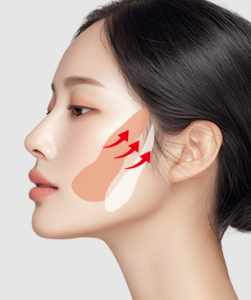 引き上げと切除