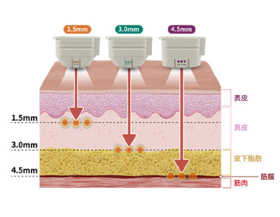 ウルセラのチップ