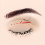 リフトアップと縫合