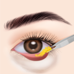 切開と脂肪処理