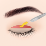 切開・脂肪除去