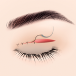 筋肉固定・縫合