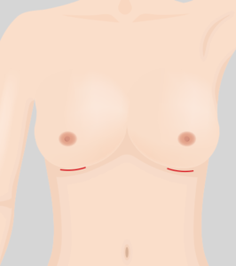 アンダーバスト切開法