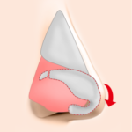 軟骨移植・延長