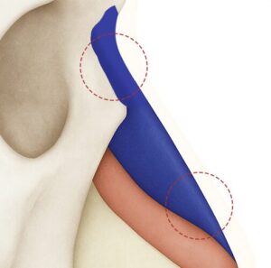 Bespokoオーダーメイドプロテーゼ