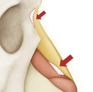 一般的なシリコンプロテーゼ